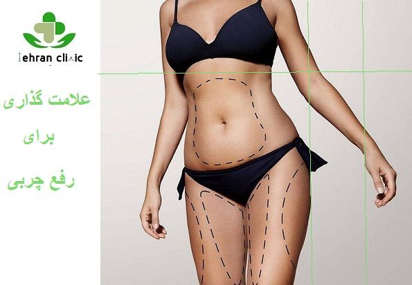 لاغری موضعی