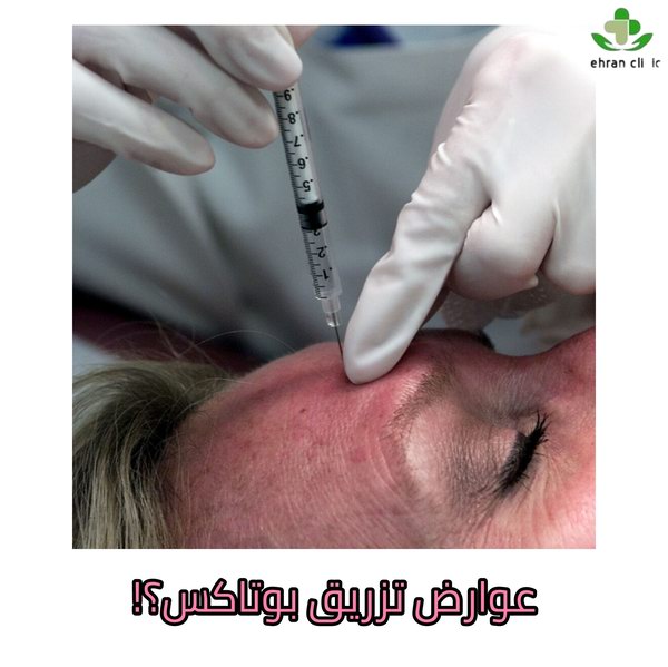 عوارض تزریق بوتاکس در غرب تهران
