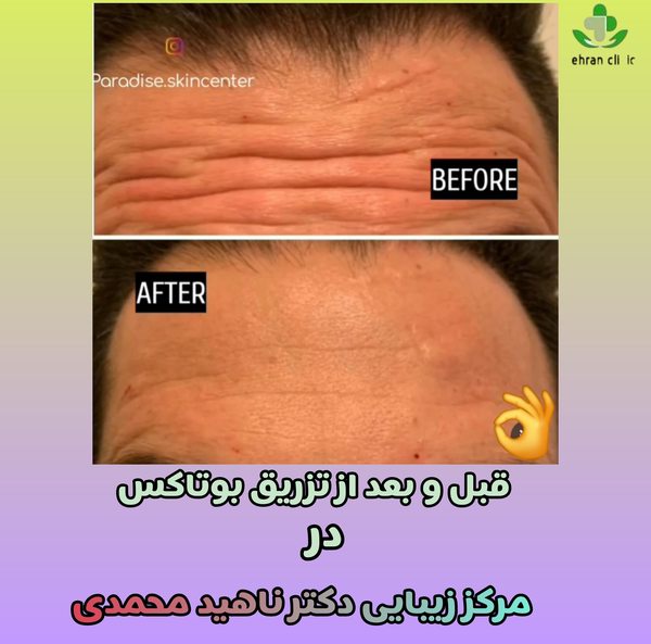 نمونه بوتاکس در غرب تهران با دکتر ناهید محمدی