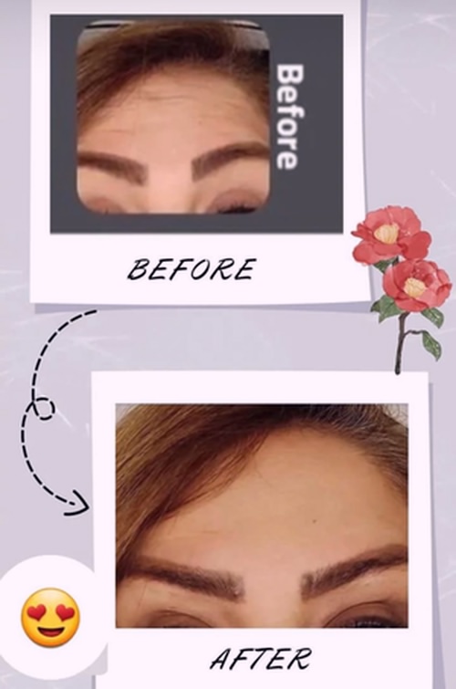 تزریق بوتاکس