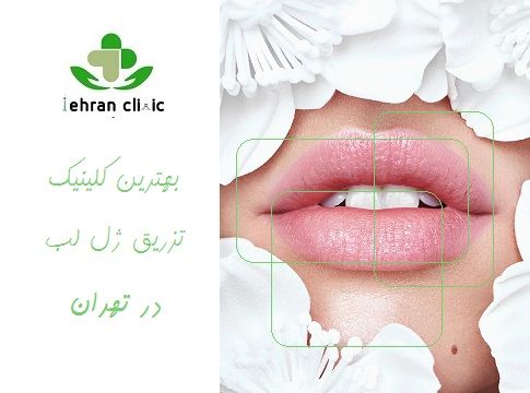 مزیت های تزریق ژل لب