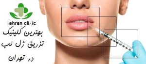 بهترین مرکز تزریق ژل لب