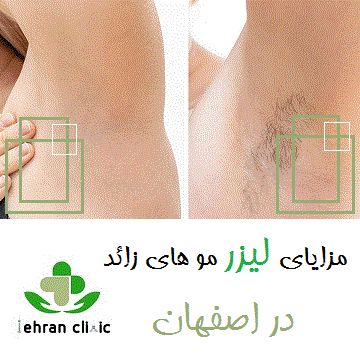 مزایای لیزر مو های زائد در اصفهان