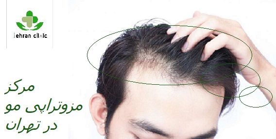 مزوتراپی موی سر