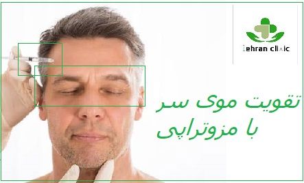تقویت موی سر و مزوتراپی