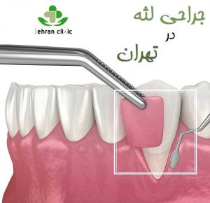 جراحی لثه در تهران