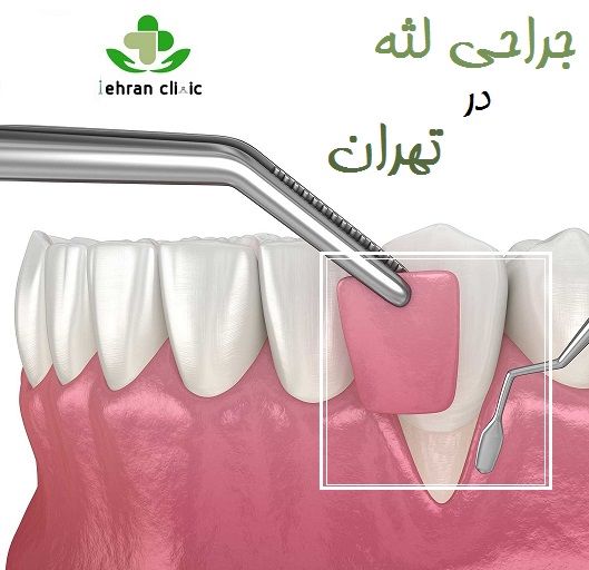 جراحی لثه در تهران