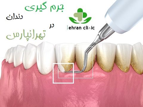 جرم گیری دندان در تهرانپارس