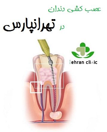 عصب کشی دندان در تهرانپارس