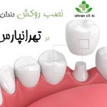  نصب روکش دندان در تهرانپارس