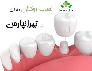  نصب روکش دندان در تهرانپارس