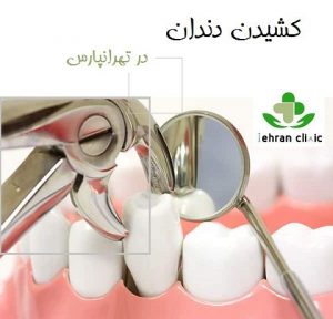 کشیدن دندان در تهرانپارس