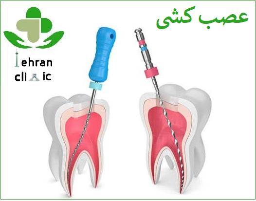 مراحل عصب کشی در تهران