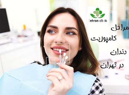 مراحل کامپوزیت دندان در تهران