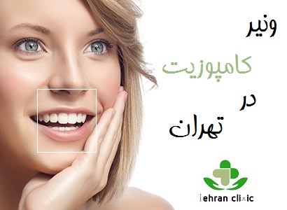 ونیر کامپوزیت در تهران