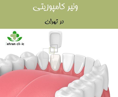 ونیر کامپوزیتی