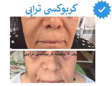 کربوکسی تراپی تهران