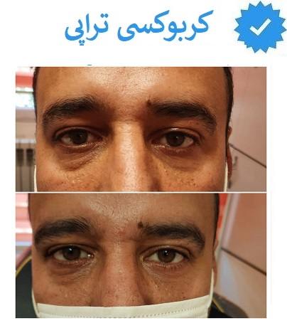 کربوکسی تراپی