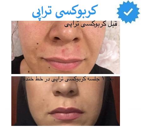  کربوکسی تراپی تهران
