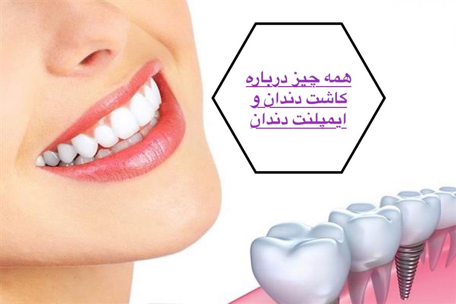 همه چیز درباره کاشت دندان و ایمپلنت دندان