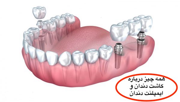  کاشت دندان و ایمپلنت دندان