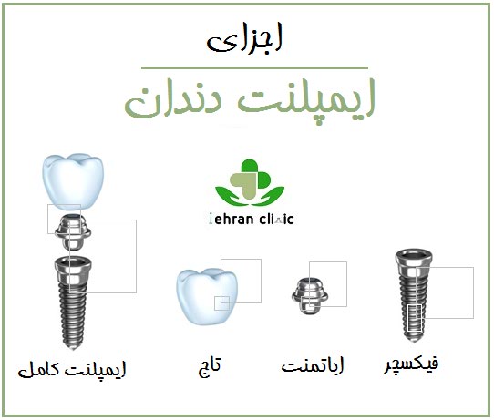 اجزای ایمپلنت دندان