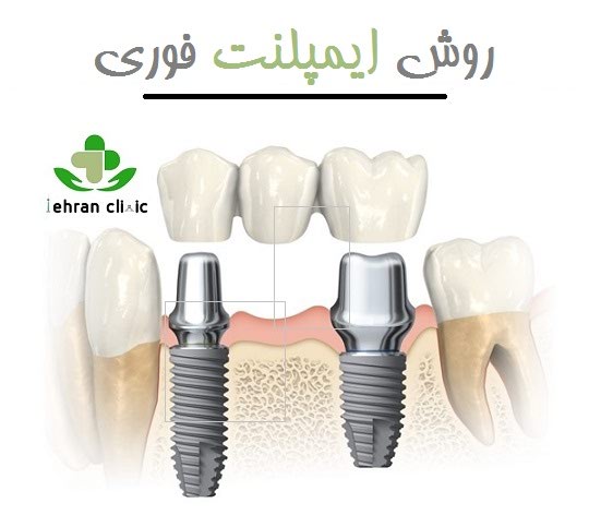 روش ایمپلنت فوری