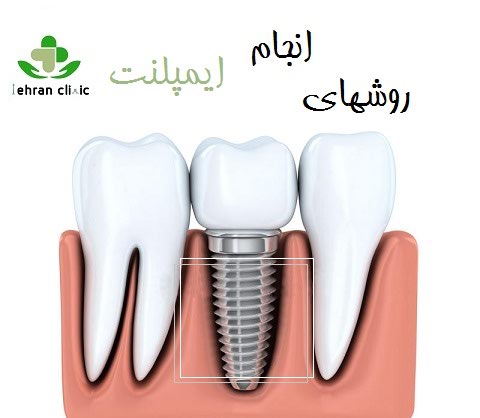 روشهای انجام ایمپلنت