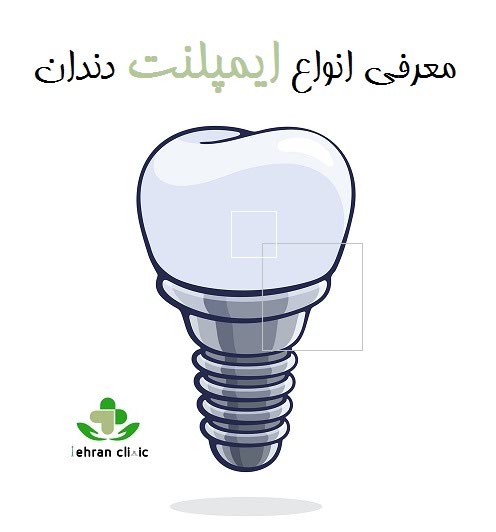 معرفی انواع ایمپلنت دندان