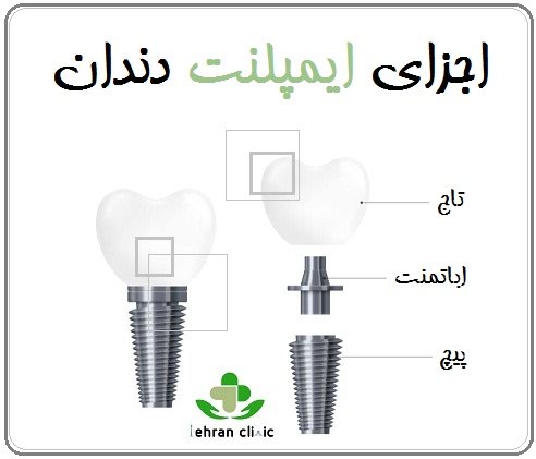اجزای ایمپلنت دندان