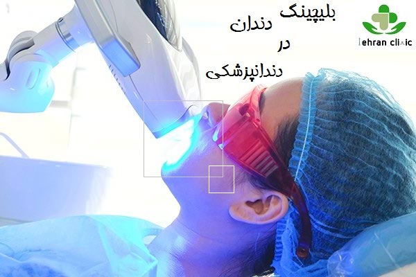 بلیچینگ دندان در دندانپزشکی