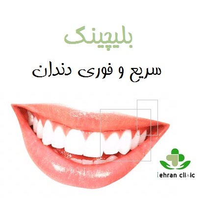 بلیچینگ سریع و فوری دندان
