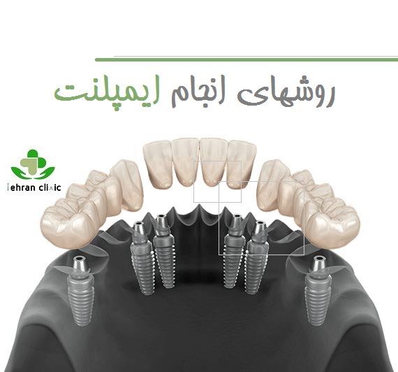 روشهای انجام ایمپلنت