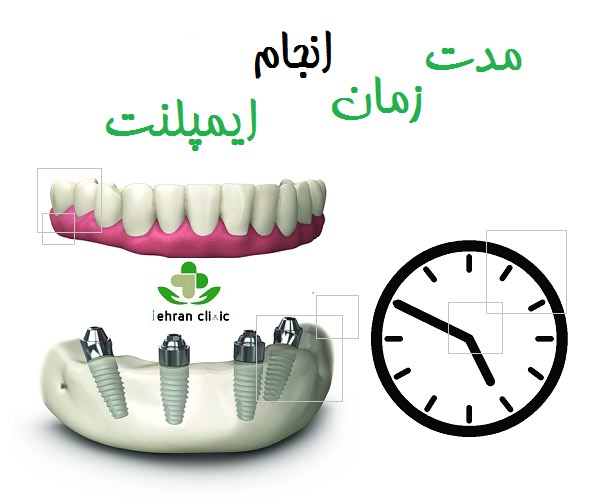 مدت زمان انجام ایمپلنت