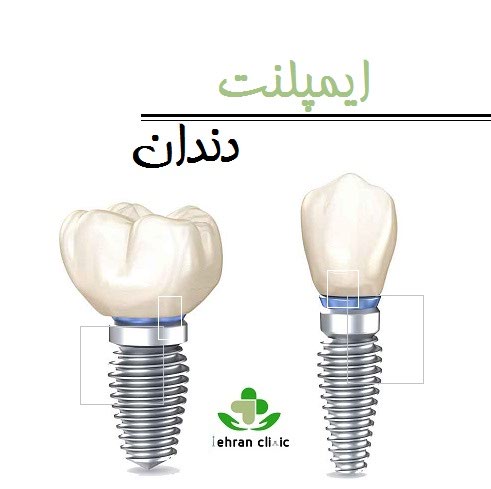 ایمپلنت دندان