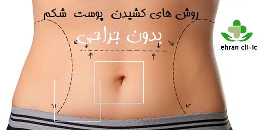 روش های کشیدن پوست شکم بدون جراحی