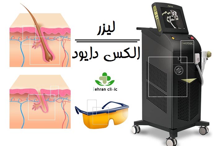 لیزر الکس دایود