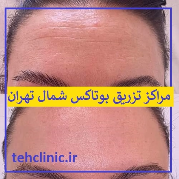 مراکز تزریق بوتاکس شمال تهران