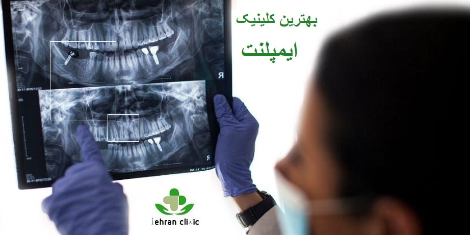 ایمپلنت 4.