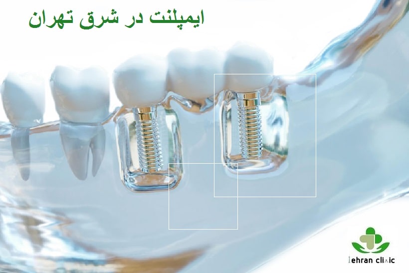 ایمپلنت 1.