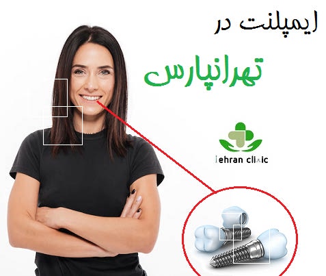 ایمپلنت در تهرانپارس