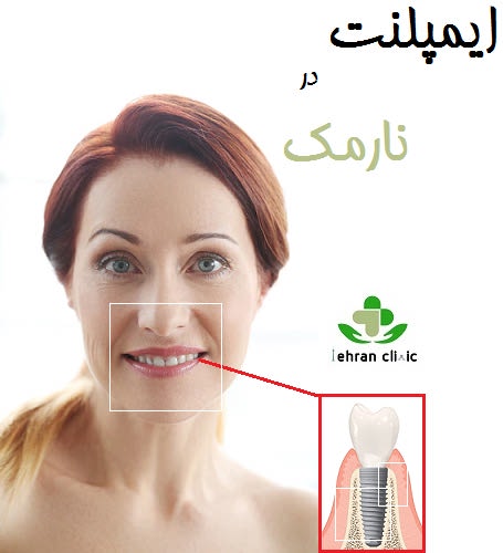 ایمپلنت در نارمک