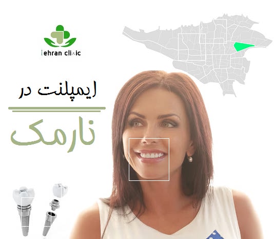 ایمپلنت در نارمک