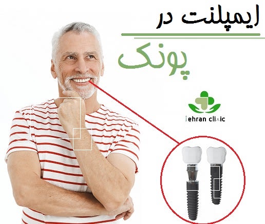 ایمپلنت در پونک