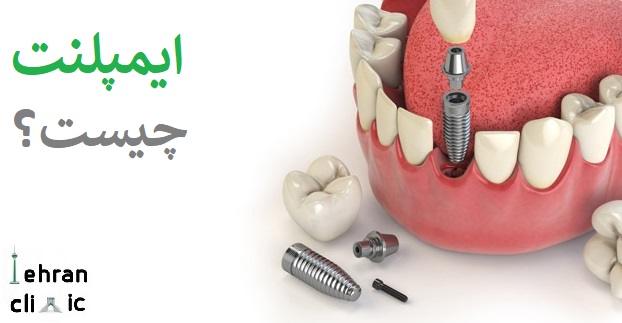 ایمپلنت چیست؟