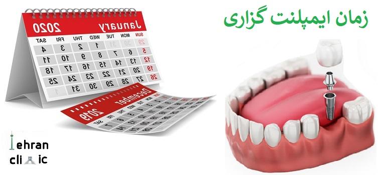 زمان ایمپلنت گذاری