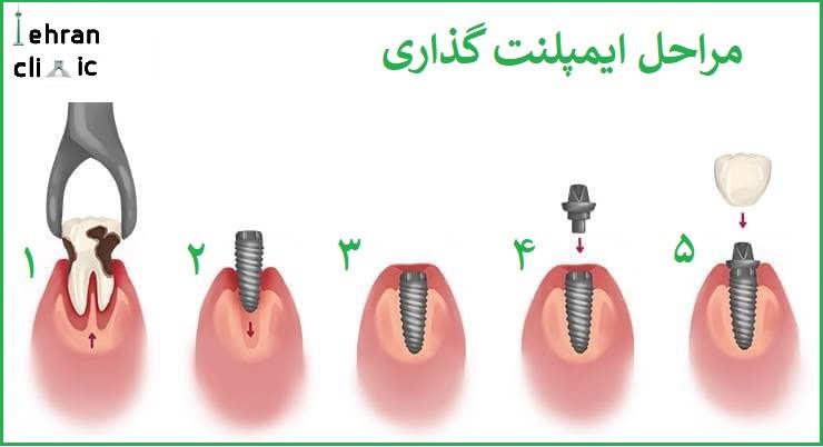مراحل کاشت ایمپلنت