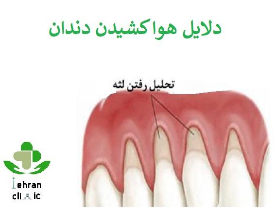 دلایل هوا کشیدن دندان چیست؟