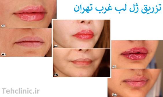 تزریق ژل لب غرب تهران