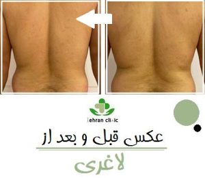عکس قبل و بعد از لاغری